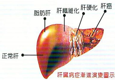 脂肪肝演變過程